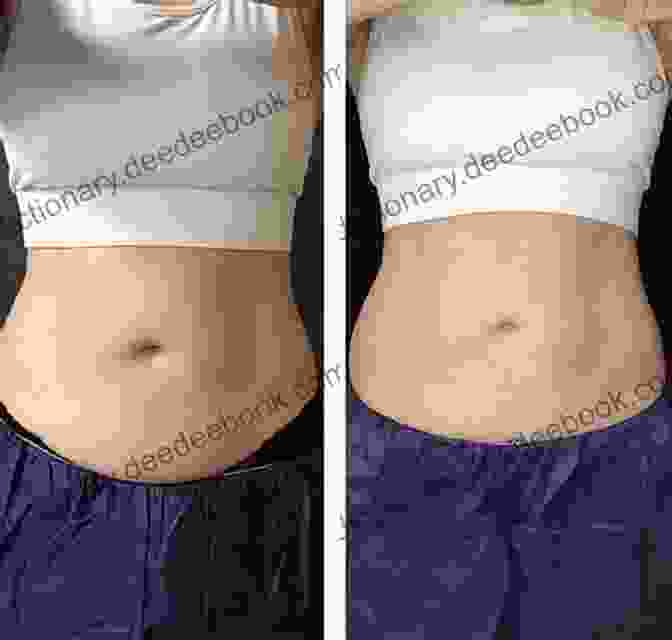 Body Contouring Before And After Results Comprehensive Body Contouring: Theory And Practice